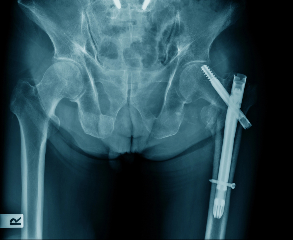 Nursing home negligence lawyers represent victims of broken femurs caused by poor facility conditions or inadequate care, pursuing compensation for medical expenses, rehabilitation, and emotional suffering.