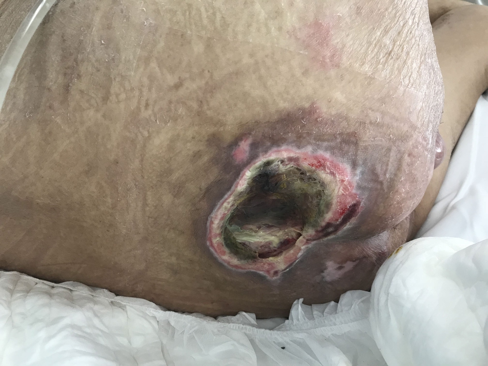 Elderly patients at higher risk of developing bedsores ending in fatality