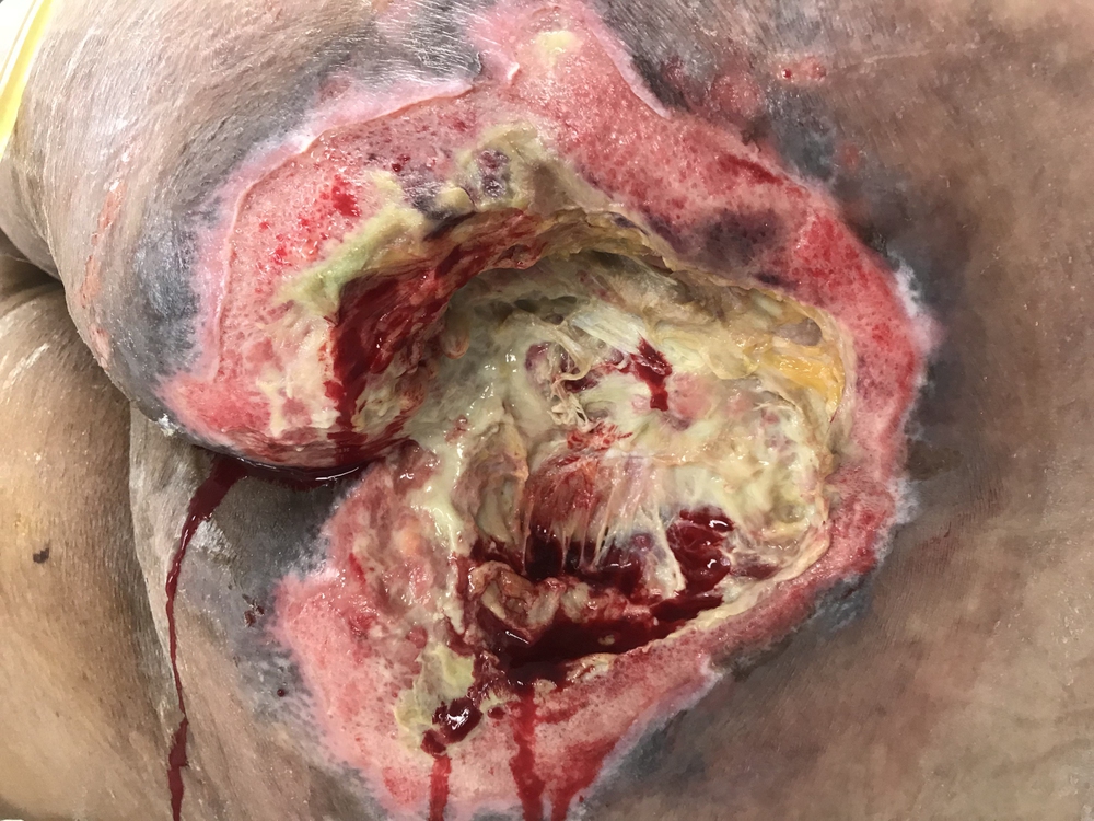 Nursing home residents suffering fatal consequences from stage 4 wounds