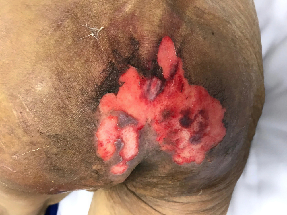 Fatal neglect cases tied to nursing home abuse and deep wounds