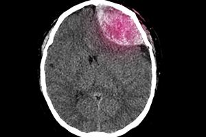Nursing home subdural hematoma lawyer representing injured residents