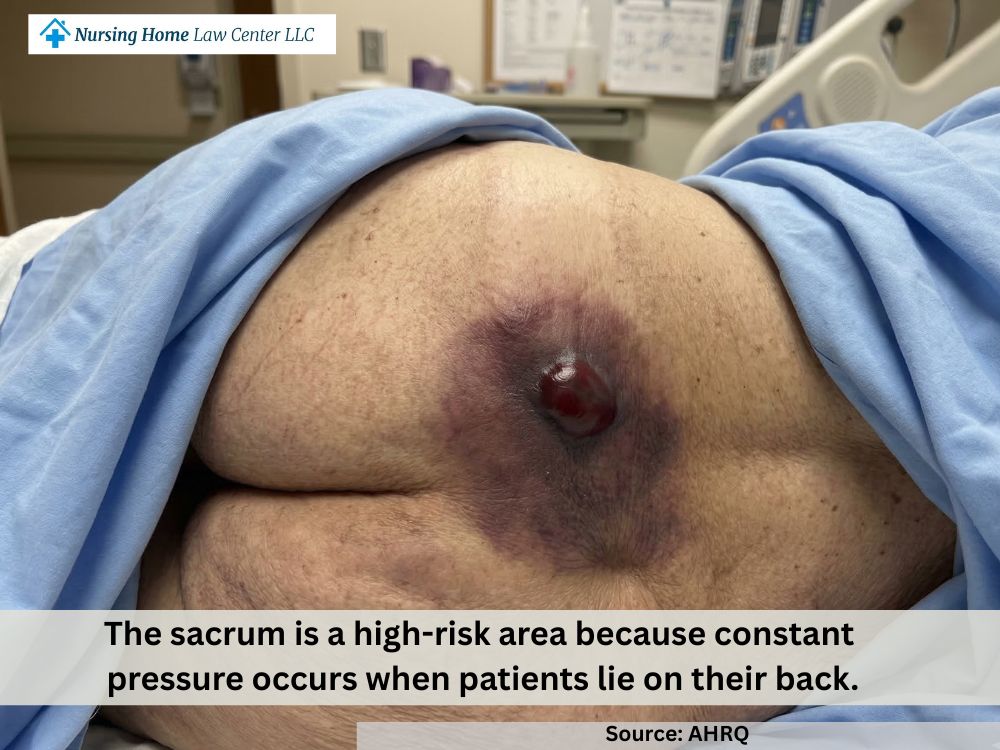 Deep tissue pressure injury near the sacrum with dark discoloration and a blood-filled blister