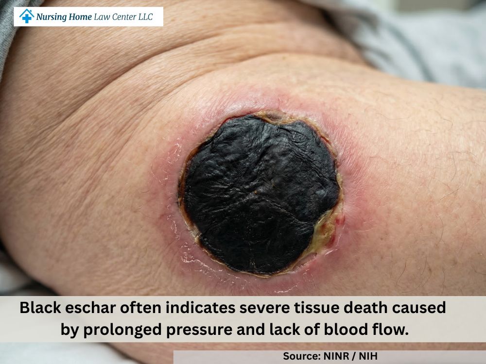 Unstageable bed sore covered by black eschar that obscures the wound depth