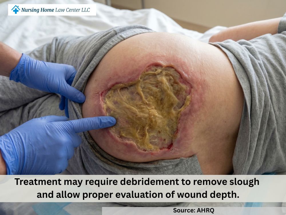 Unstageable bed sore with yellow slough covering the wound bed and hiding depth
