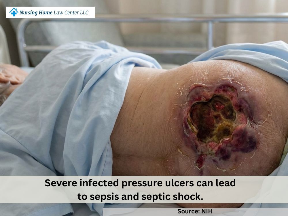 Serious infected bedsore on a nursing home resident showing advanced skin breakdown and risk of fatal complications